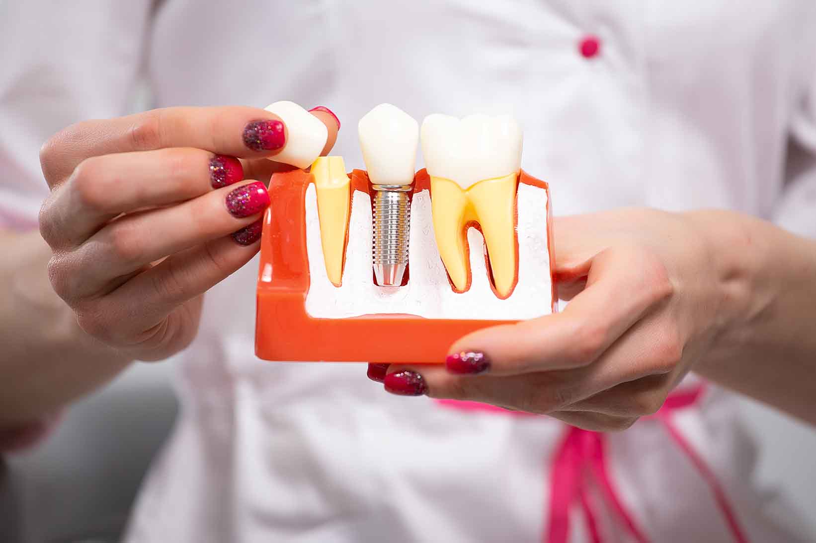 How Long Do Dental Implants Last? | Your Complete Guide from Wilmslow Dental Centre